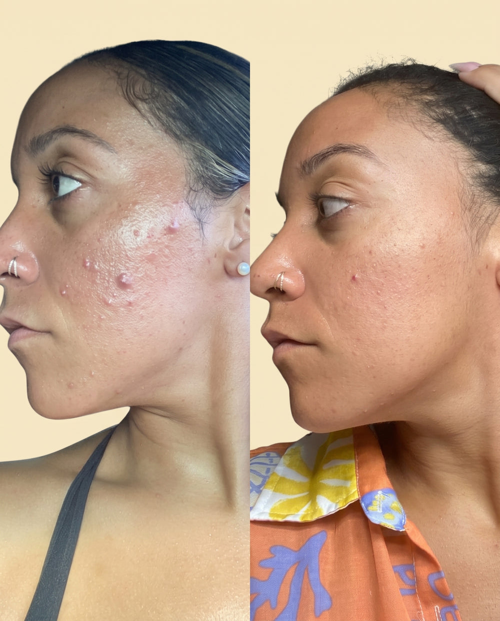 Serums didn't work. Harsh acids stung. And the spots stayed.